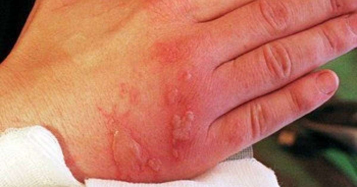 Күйік шалғандағы халық емі