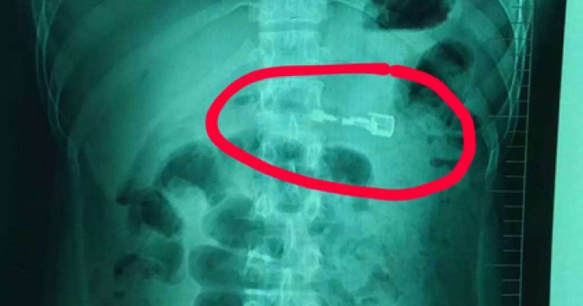 Зажигалка жұтып қойған мас қытайдың асқазаны жарыла жаздады