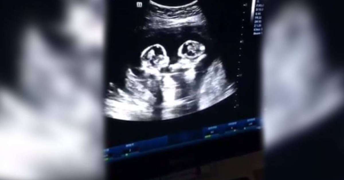 Құрсақта жатқан егіздер "төбелесті" - видео