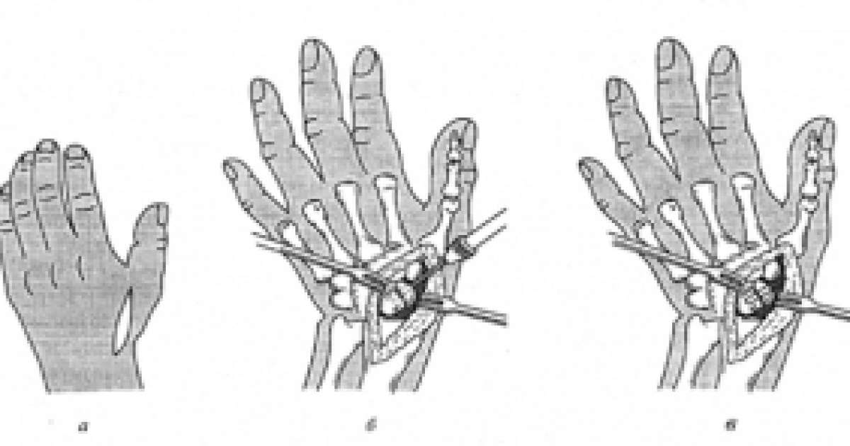 Галеация зақымдануы | KazMedic