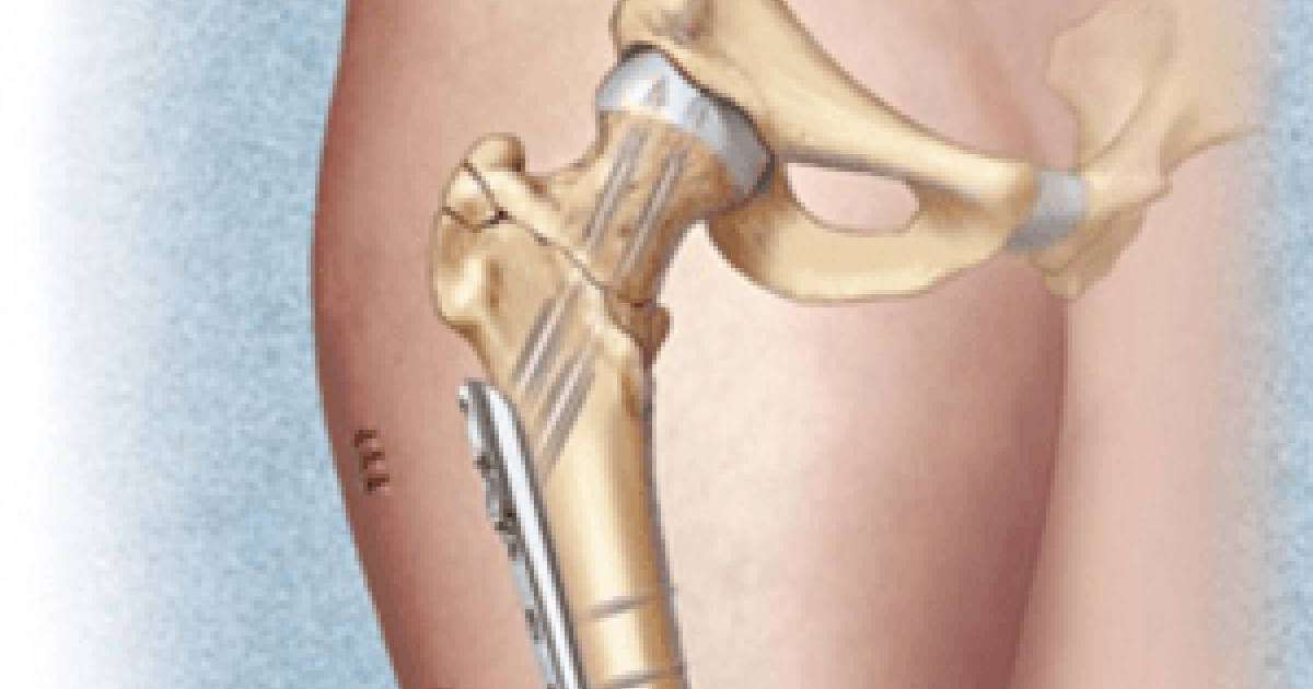 Сан диафизі сынықтары. | KazMedic