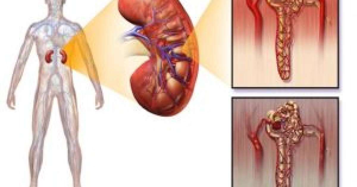 Интерстициальды нефрит