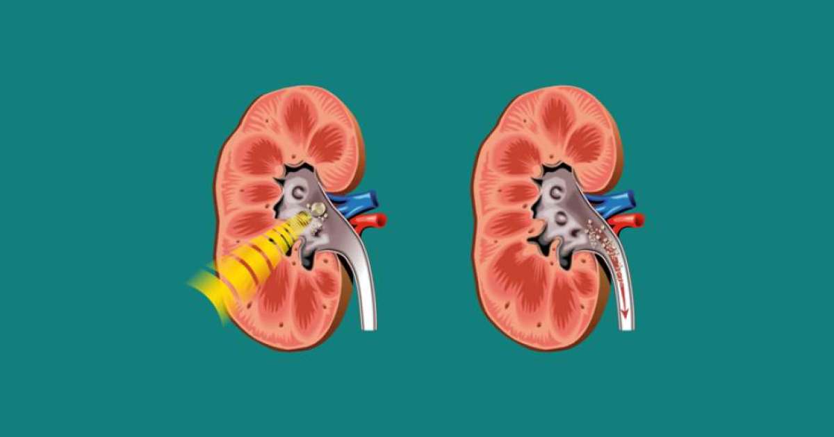 Несеп жолдарының тас ауруы - Денсаулық - Bilim