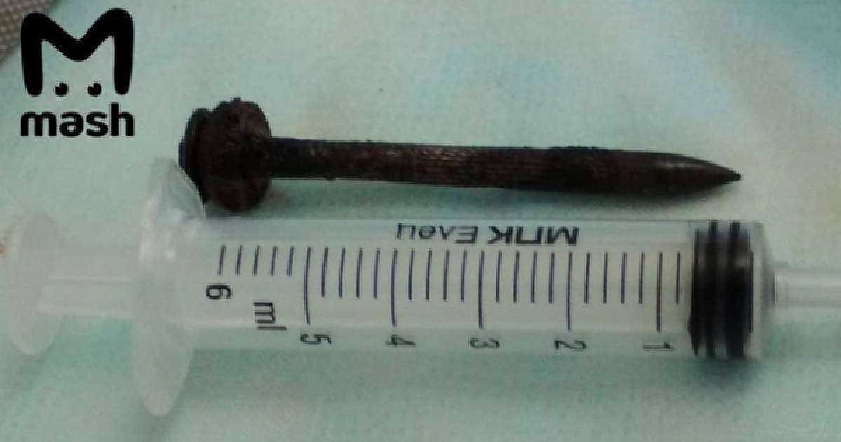 Ер адам басына кіріп кеткен шегемен екі жыл өмір сүрген