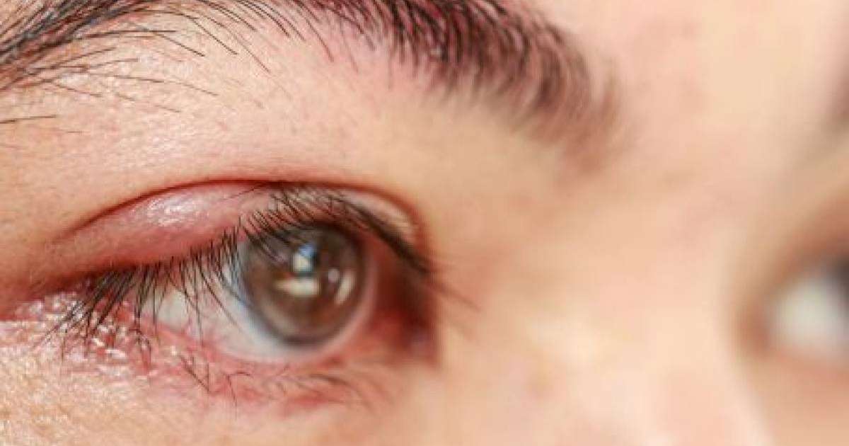 Теріскенді қалай емдеуге болады?