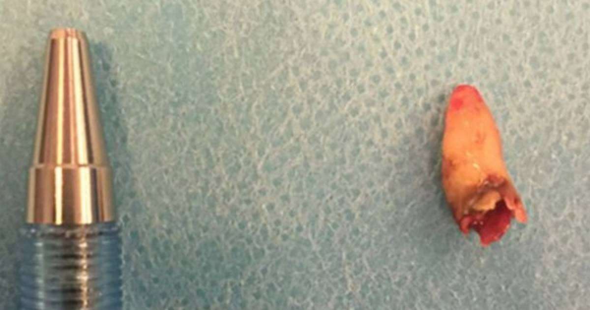 Науқастың мұрнынан тіс өсіп шыққан