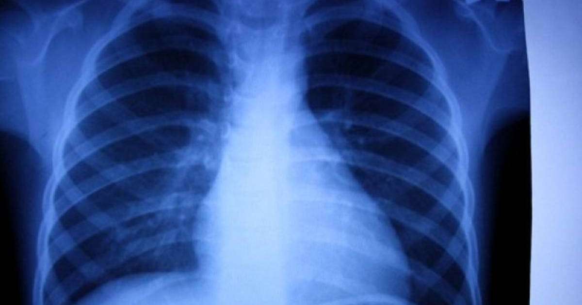 Астанадағы туберкулезге ұшырағандардың көбісі жалға пәтер алып тұратындар