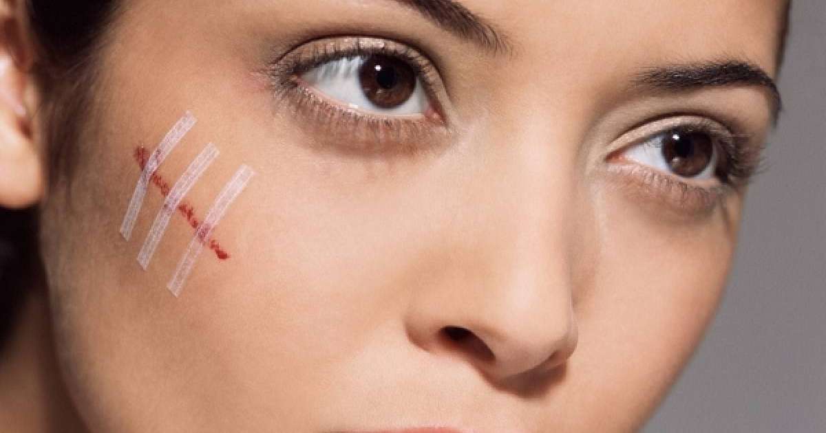 Тыртықтан қалай арылуға болады? | Reactor.inform.kz