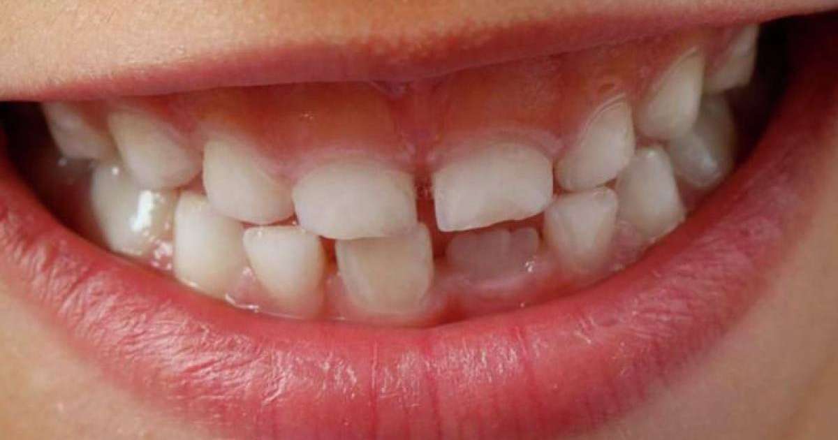 Дәрігерлер баланың 526 тісін жұлып тастады – видео