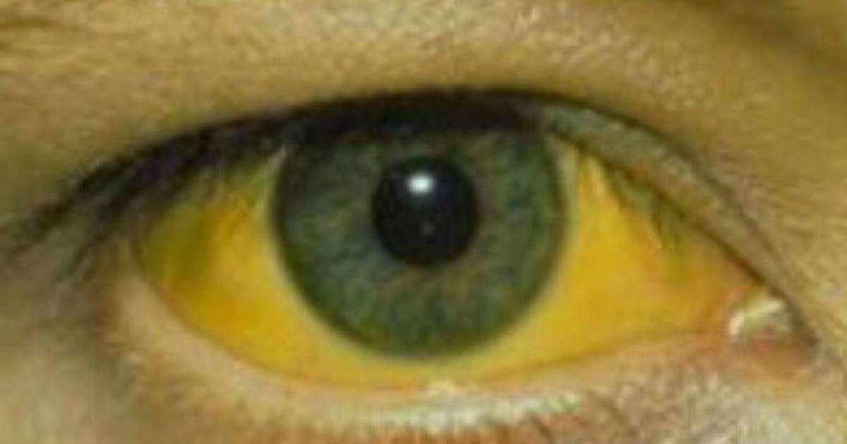 Сарыаурудан сауықтыру халық емі