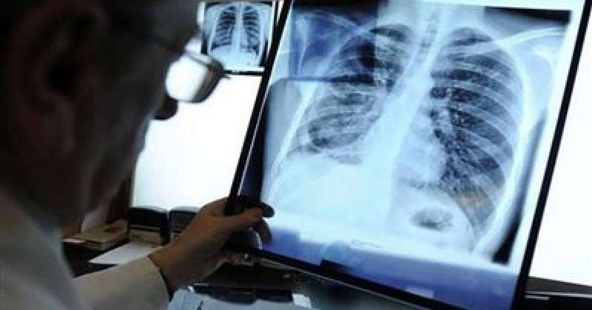 Туберкулездің қауіпті түрімен ауыратын 6 адам іздестіріліп жатыр