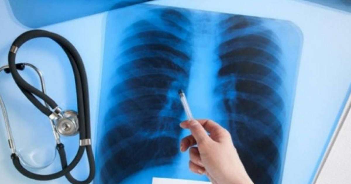 Алматыда туберкулезді емдеуге 4,2 млрд теңге бөлінді