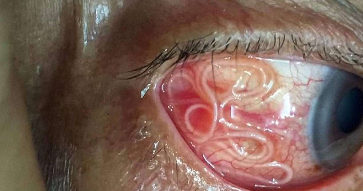 Дәрігерлер сәбидің көзінен 11 құрт алып шықты – жұрттың зәресін алған фото