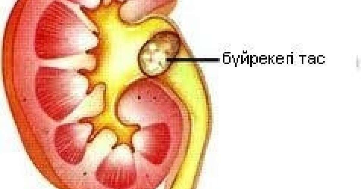 Бүйре қуық жолдарындағы тастан құтылу