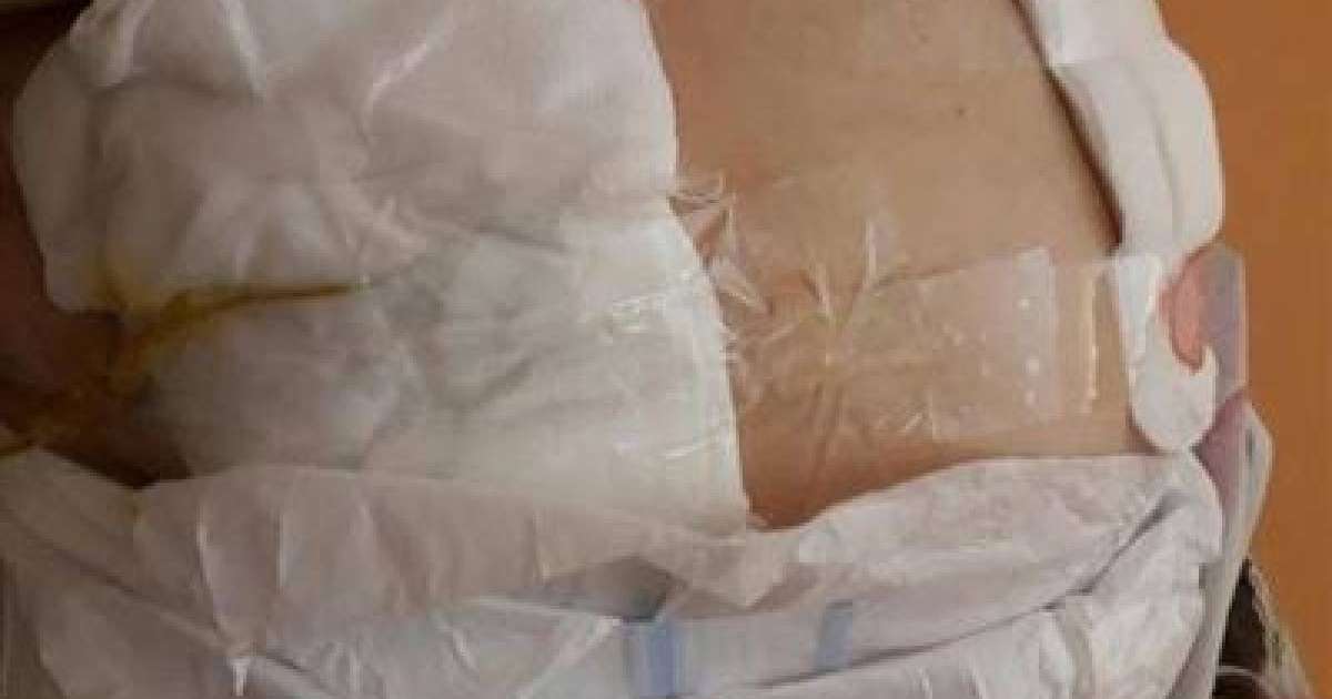 Ота жасатқан науқастың жарасын скотчпен таңып берген