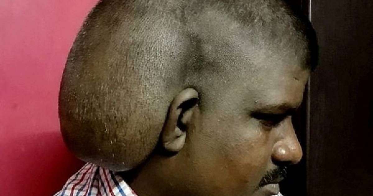 Адамның басына 5 келі ісік өсіп шыққан