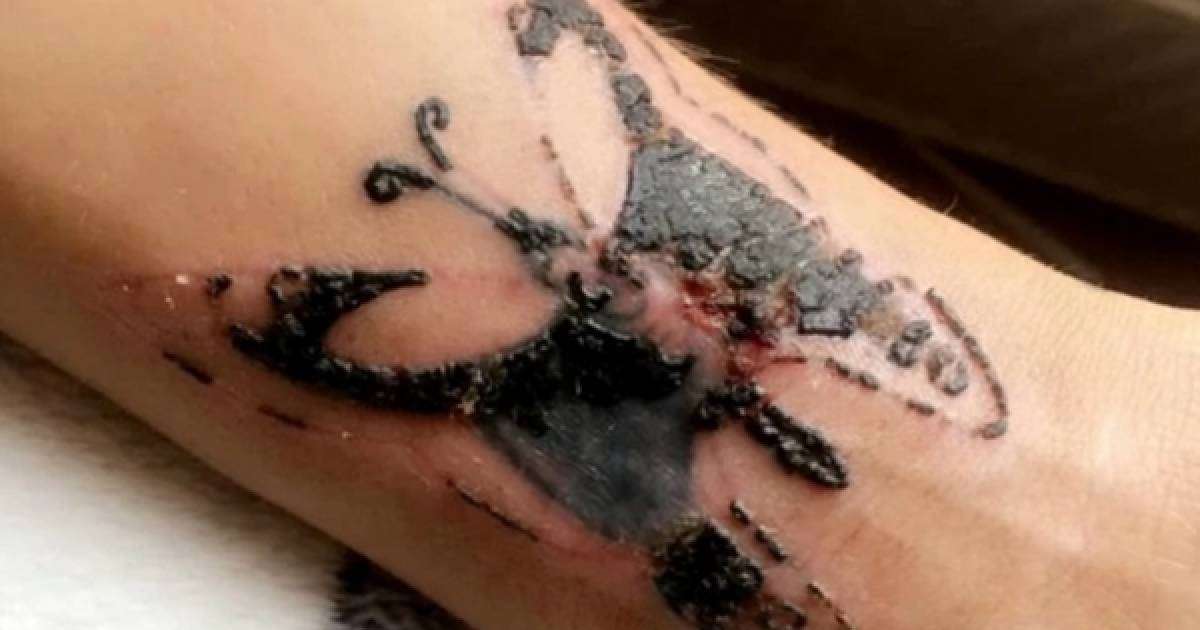 ​Тату салдырған бойжеткен аса қауіпті инфекция жұқтырған