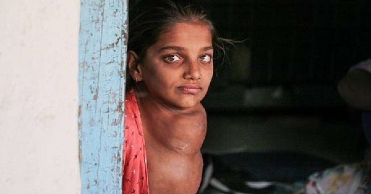 Бүлдіршіннің мойынына басындай көлемді ісік өскен