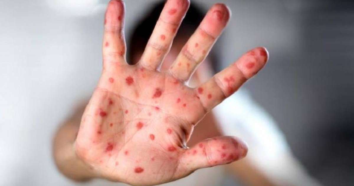 西哈州确诊麻疹病患人数82人