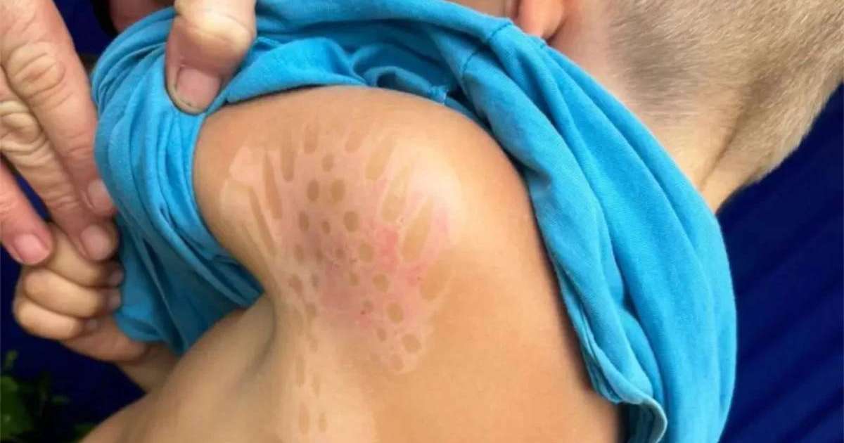 "Үтіктің іздері қалған": Талдықорғанда полиция арнайы балалар орталығындағы азаптау фактілерінен кейін тергеу бастады