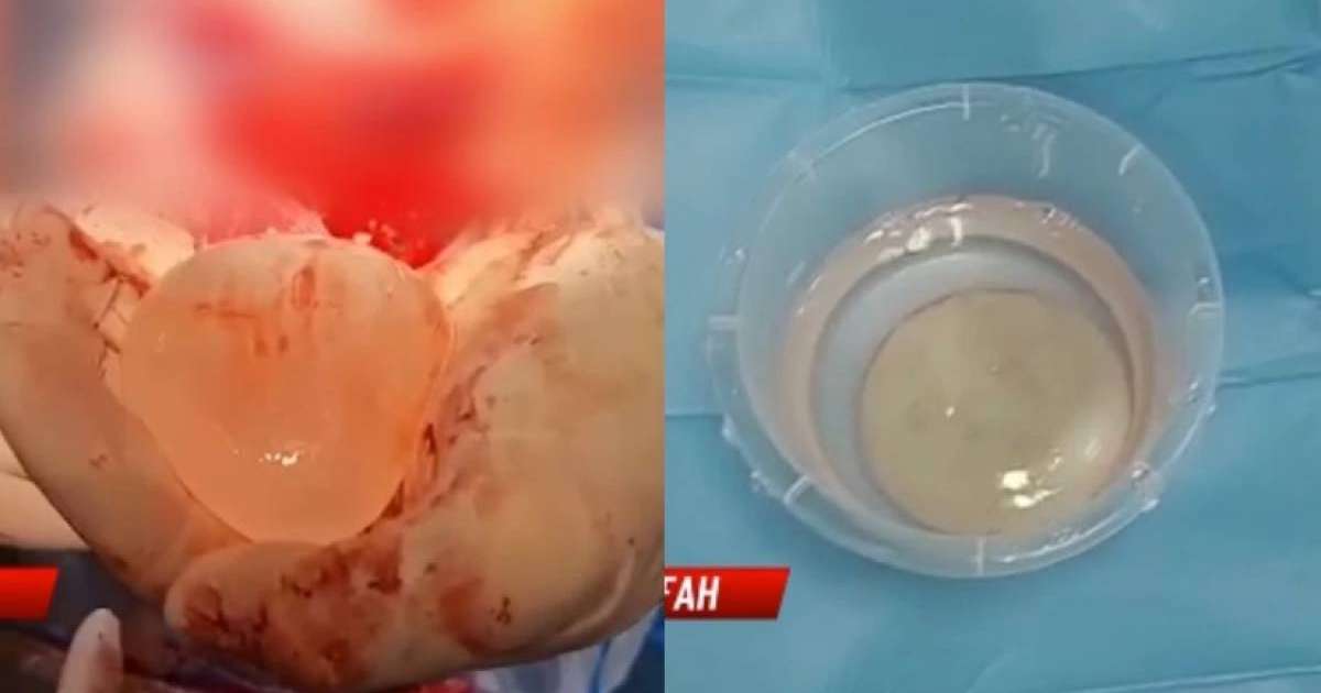 Семейде дәрігерлер бойжеткеннің миынан 7 сантиметрлік құрт алды