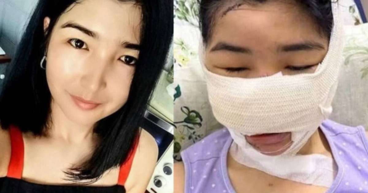 Мұрны мен құлағын кескен: күйеуінен зардап шеккен келіншекке ота жасалды