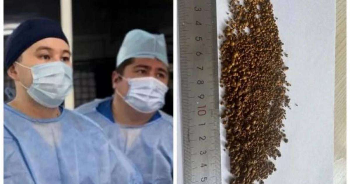 Алматылық дәрігерлер науқастың өт қабынан 5 499 тас алған