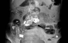 Қыз баланың ішінен шаш, қалам, темір және скточ шықты