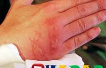 Күйік шалғандағы халық емі