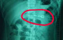 Зажигалка жұтып қойған мас қытайдың асқазаны жарыла жаздады