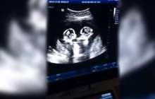 Құрсақта жатқан егіздер "төбелесті" - видео