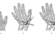 Галеация зақымдануы | KazMedic