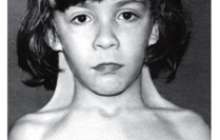 Хромосоманың Х моносомия синдромы (Шершевский-Тернер синдромы, Тернер синдромы,ХО- синдромы)