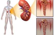 Интерстициальды нефрит