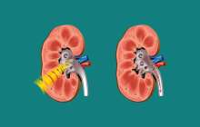 Несеп жолдарының тас ауруы - Денсаулық - Bilim