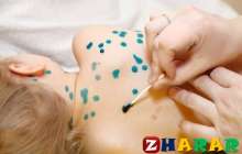 Шешекпен ауырған баланы емдеудің жолдары