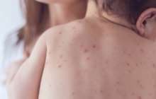 Денсаулық сақтау министрлігі қызылша ауруының өршу себебін түсіндірді