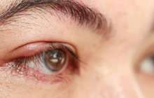 Теріскенді қалай емдеуге болады?