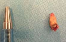 Науқастың мұрнынан тіс өсіп шыққан