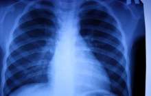 Астанадағы туберкулезге ұшырағандардың көбісі жалға пәтер алып тұратындар