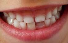 Дәрігерлер баланың 526 тісін жұлып тастады – видео