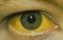 Сарыаурудан сауықтыру халық емі