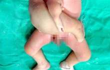 Ұзаққа созылған ота: нәрестенің беріш-егізі кесіп алынды