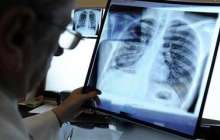 Туберкулездің қауіпті түрімен ауыратын 6 адам іздестіріліп жатыр