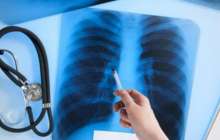 Алматыда туберкулезді емдеуге 4,2 млрд теңге бөлінді