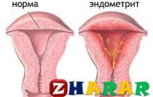 Эндометрит