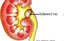 Бүйре қуық жолдарындағы тастан құтылу