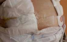 Ота жасатқан науқастың жарасын скотчпен таңып берген