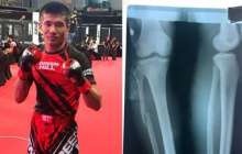 Қазақстандық спортшы сынған аяғымен жеңіске жетті