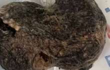 Жамбыл облысында бойжеткеннің асқазанынан 30 сантиметрлік тығыз шаш түйіні шықты